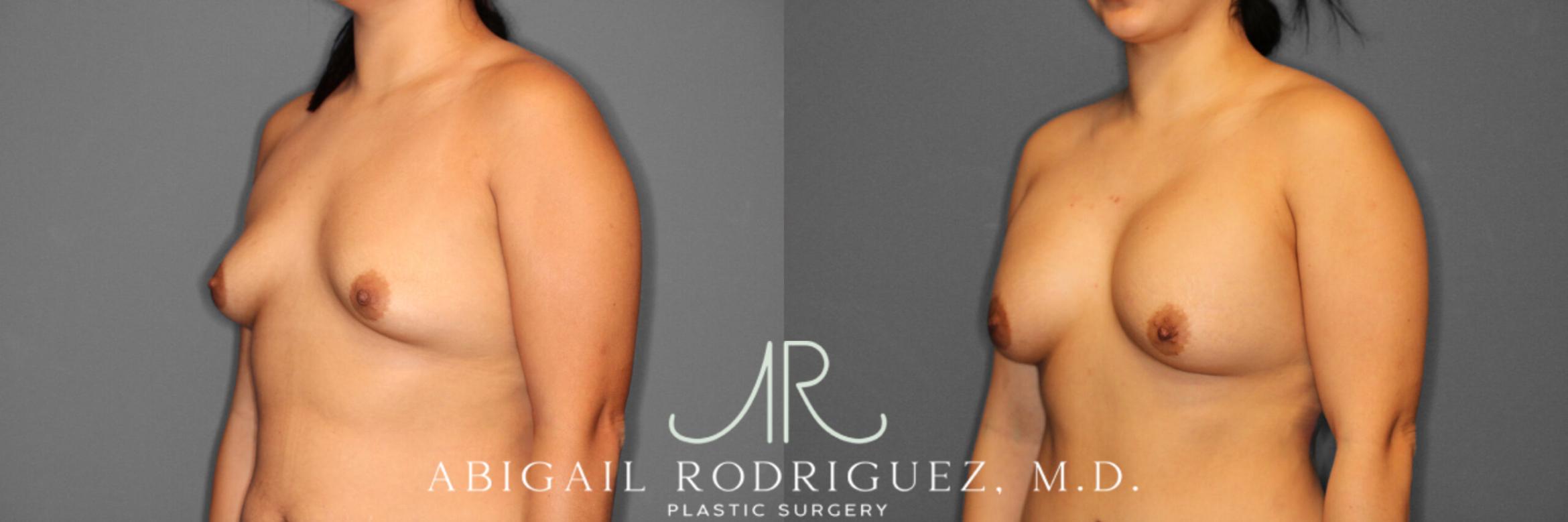 Before & After Breast Augmentation Case 254006 View 2 View in Houston, TX