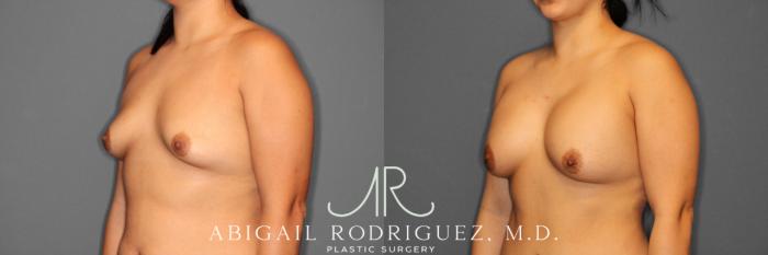 Before & After Breast Augmentation Case 254006 View 2 View in Houston, TX