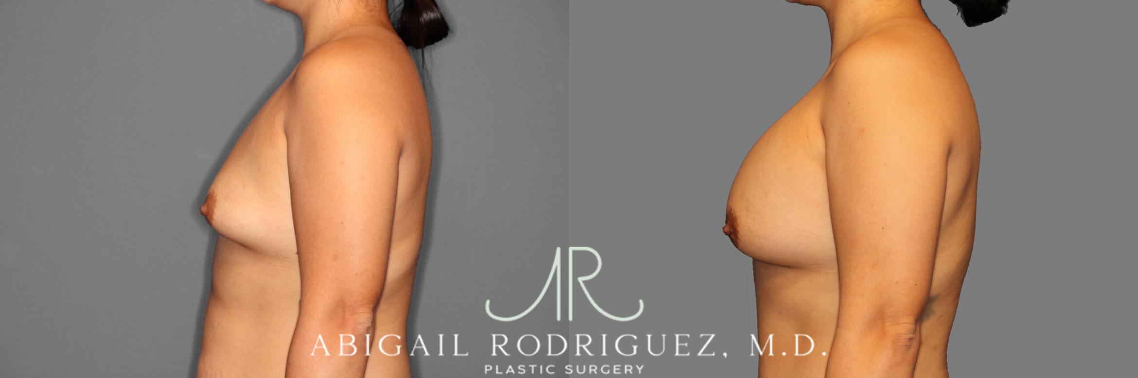 Before & After Breast Augmentation Case 254006 View 3 View in Houston, TX