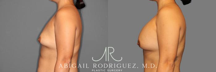 Before & After Breast Augmentation Case 254006 View 3 View in Houston, TX