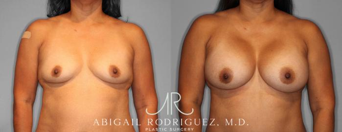 Before & After Breast Augmentation Case 254188 View 1 View in Houston, TX
