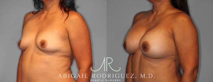 Before & After Breast Augmentation Case 254188 View 2 View in Houston, TX