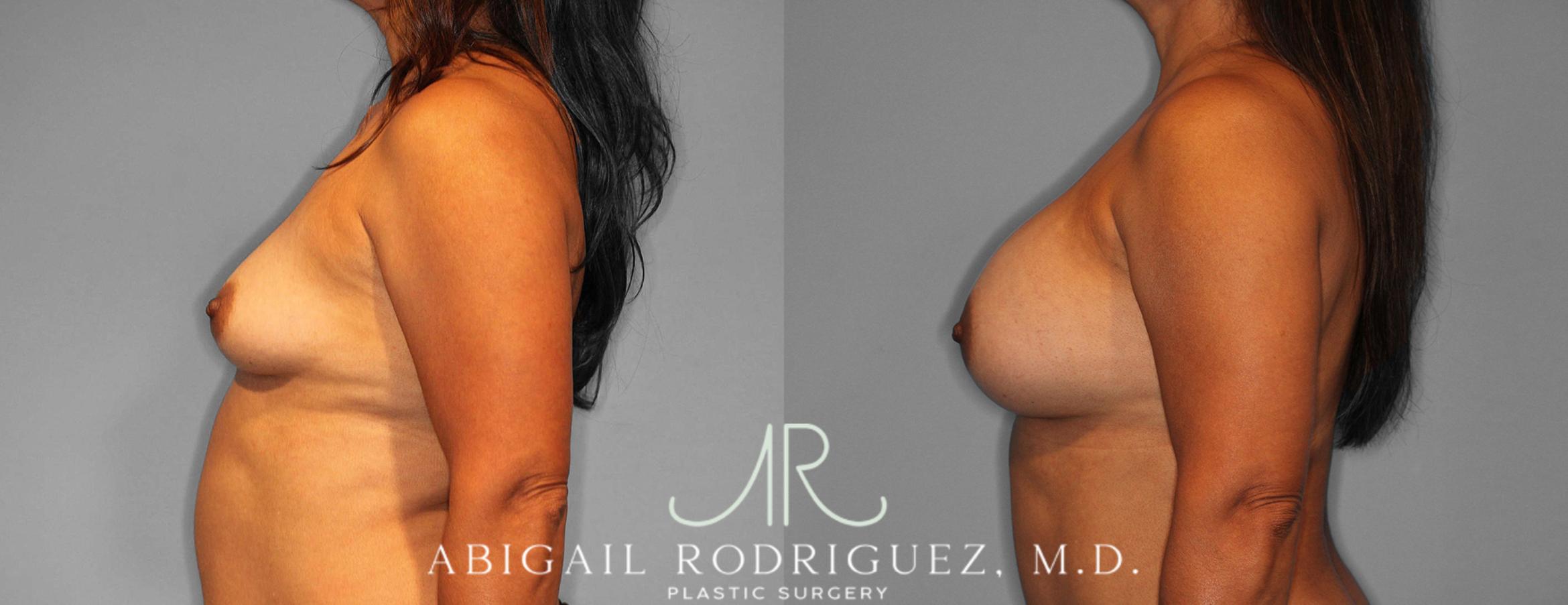 Before & After Breast Augmentation Case 254188 View 3 View in Houston, TX