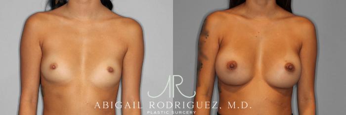Before & After Breast Augmentation Case 254337 View 1 View in Houston, TX
