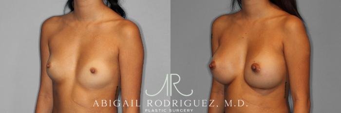 Before & After Breast Augmentation Case 254337 View 2 View in Houston, TX