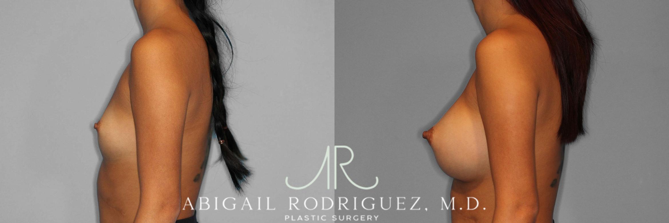 Before & After Breast Augmentation Case 254337 View 3 View in Houston, TX