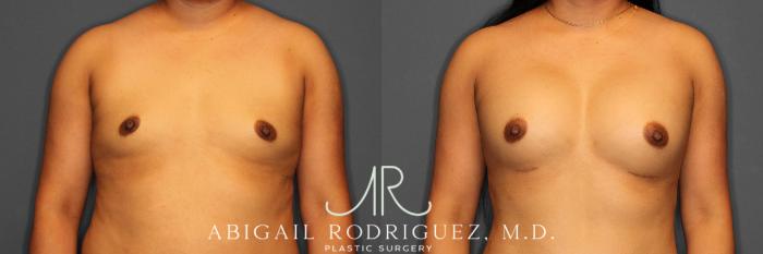 Before & After Breast Augmentation Case 254521 View 1 View in Houston, TX