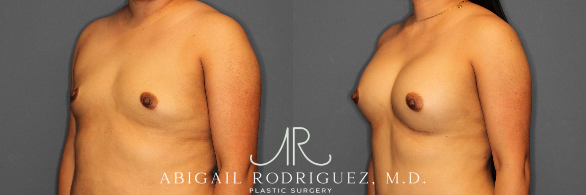 Before & After Breast Augmentation Case 254521 View 2 View in Houston, TX