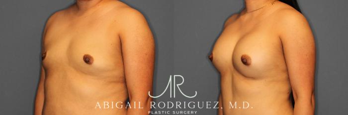 Before & After Breast Augmentation Case 254521 View 2 View in Houston, TX