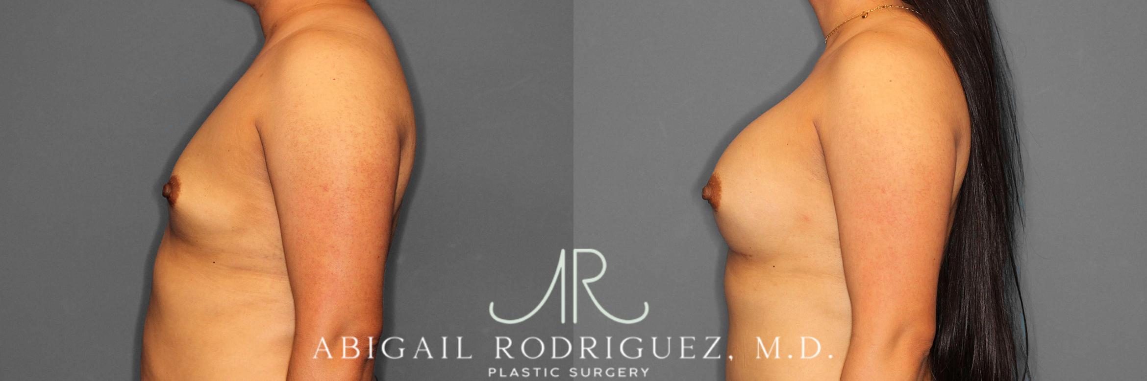 Before & After Breast Augmentation Case 254521 View 3 View in Houston, TX
