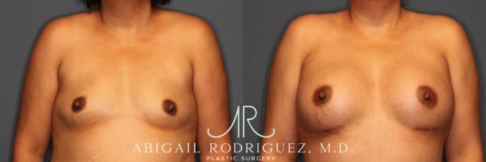Before & After Fat Grafting Case 254919 View 1 View in Houston, TX