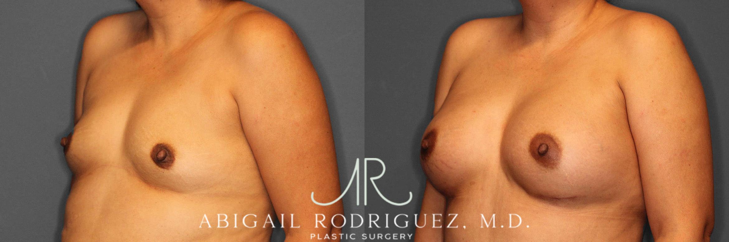 Before & After Breast Augmentation Case 254919 View 2 View in Houston, TX