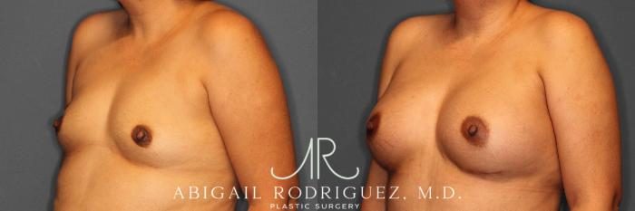Before & After Breast Augmentation Case 254919 View 2 View in Houston, TX