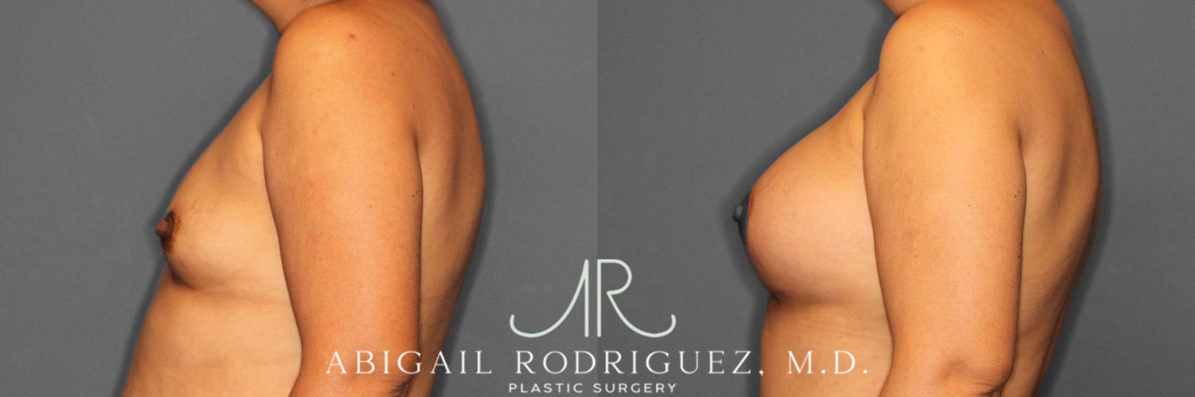 Before & After Breast Augmentation Case 254919 View 3 View in Houston, TX