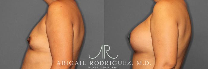 Before & After Breast Augmentation Case 254919 View 3 View in Houston, TX