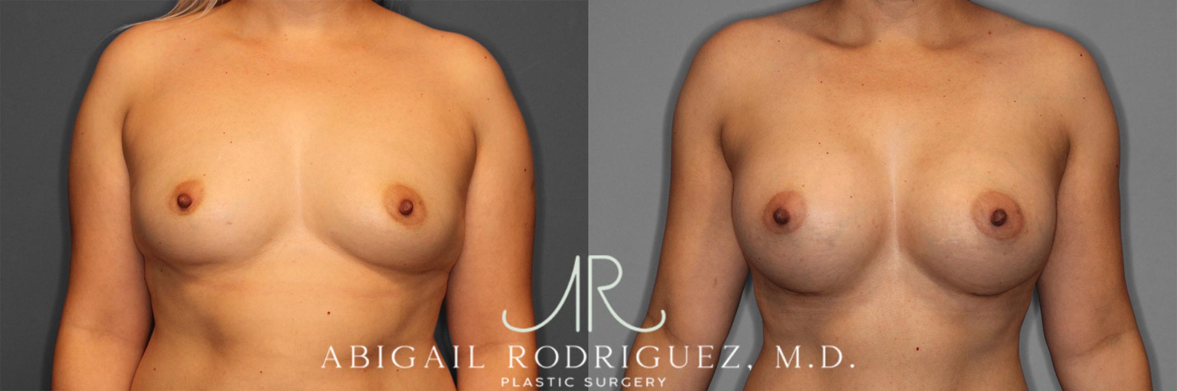 Before & After Breast Augmentation Case 257282 View 1 View in Houston, TX