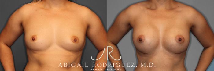 Before & After Breast Augmentation Case 257282 View 2 View in Houston, TX