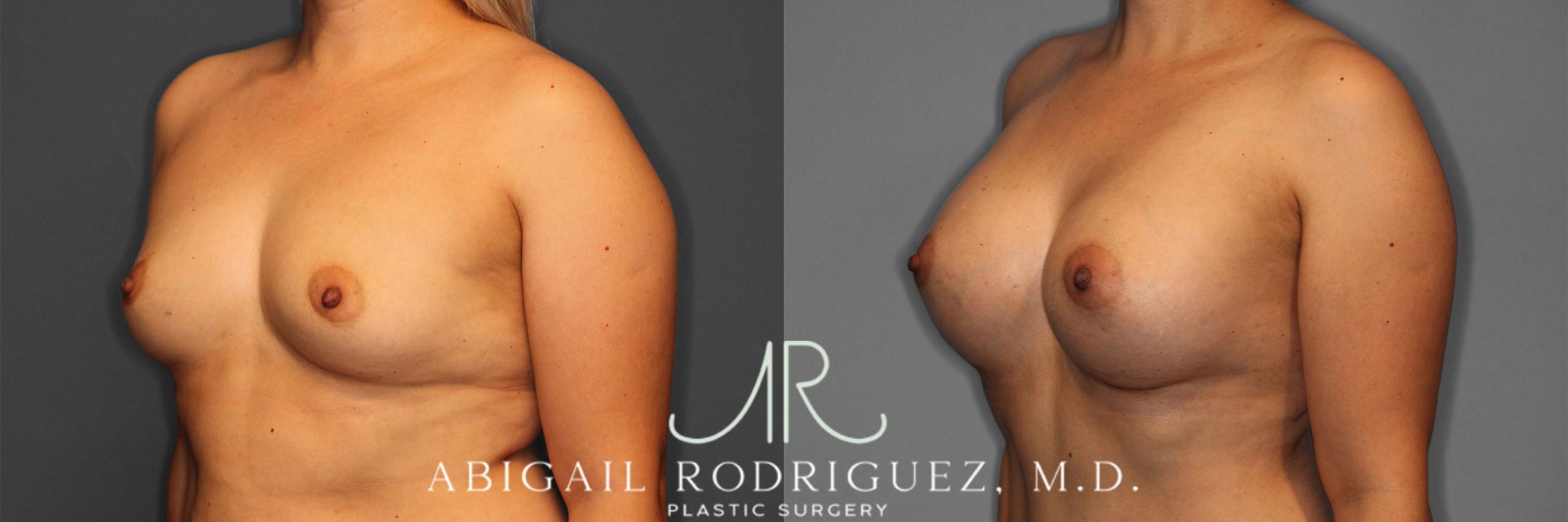 Before & After Breast Augmentation Case 257282 View 3 View in Houston, TX