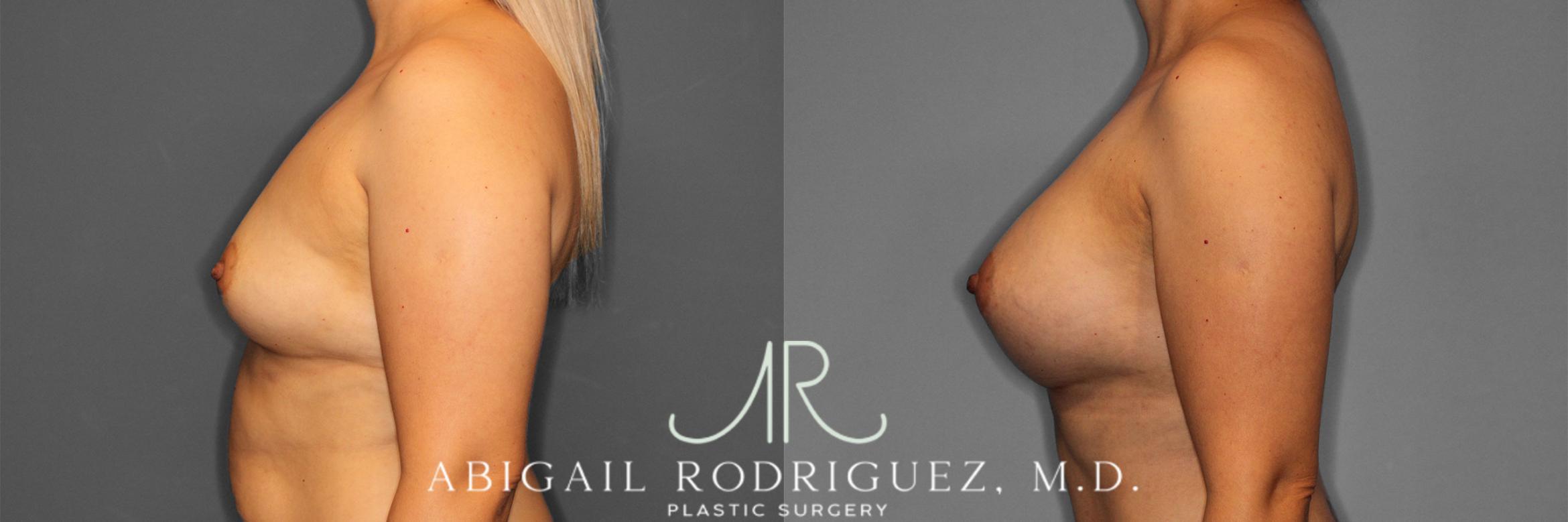 Before & After Breast Augmentation Case 257282 View 4 View in Houston, TX