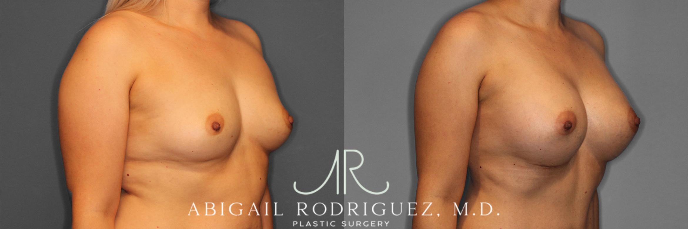 Before & After Breast Augmentation Case 257282 View 5 View in Houston, TX