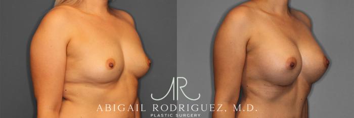 Before & After Breast Augmentation Case 257282 View 5 View in Houston, TX