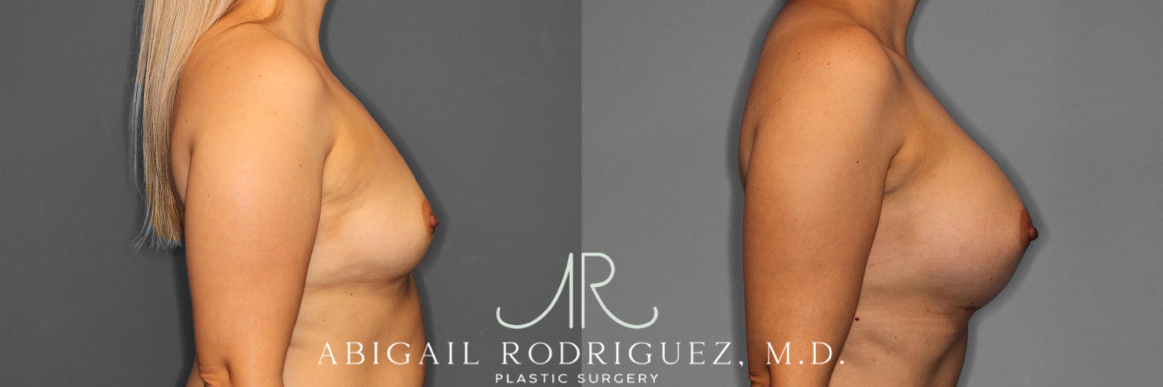 Before & After Breast Augmentation Case 257282 View 6 View in Houston, TX