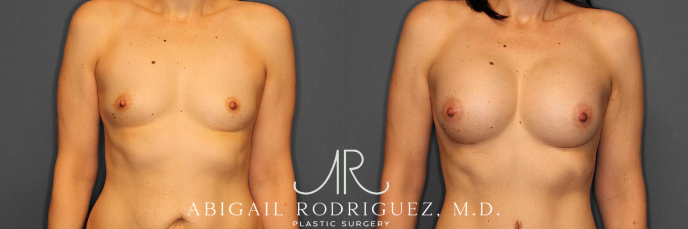 Before & After Breast Augmentation Case 257444 View 1 View in Houston, TX