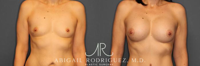 Before & After Breast Augmentation Case 257444 View 1 View in Houston, TX