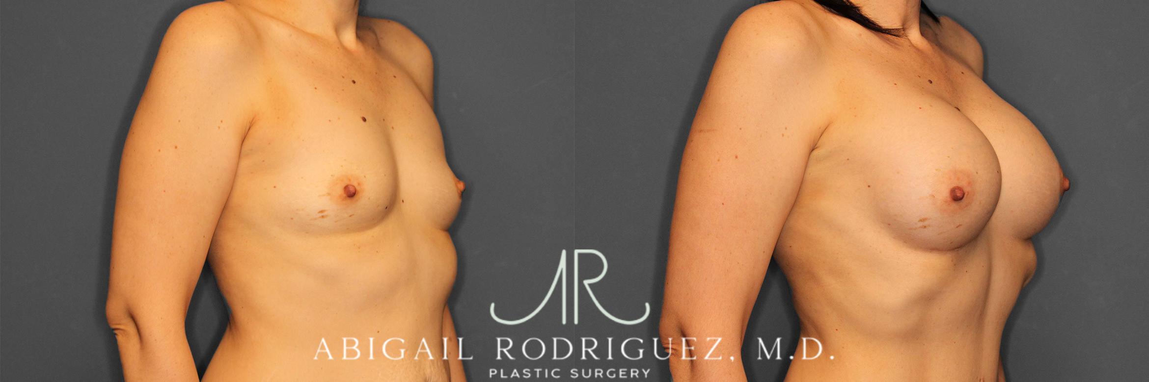 Before & After Breast Augmentation Case 257444 View 3 View in Houston, TX