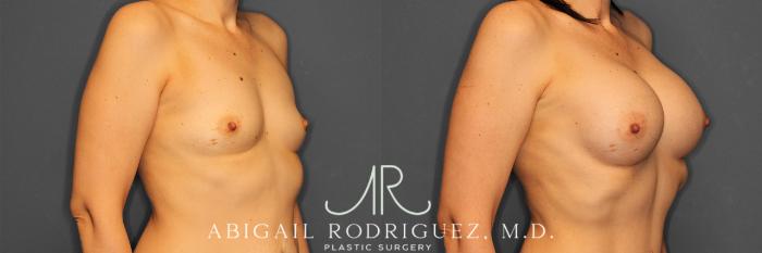 Before & After Breast Augmentation Case 257444 View 3 View in Houston, TX