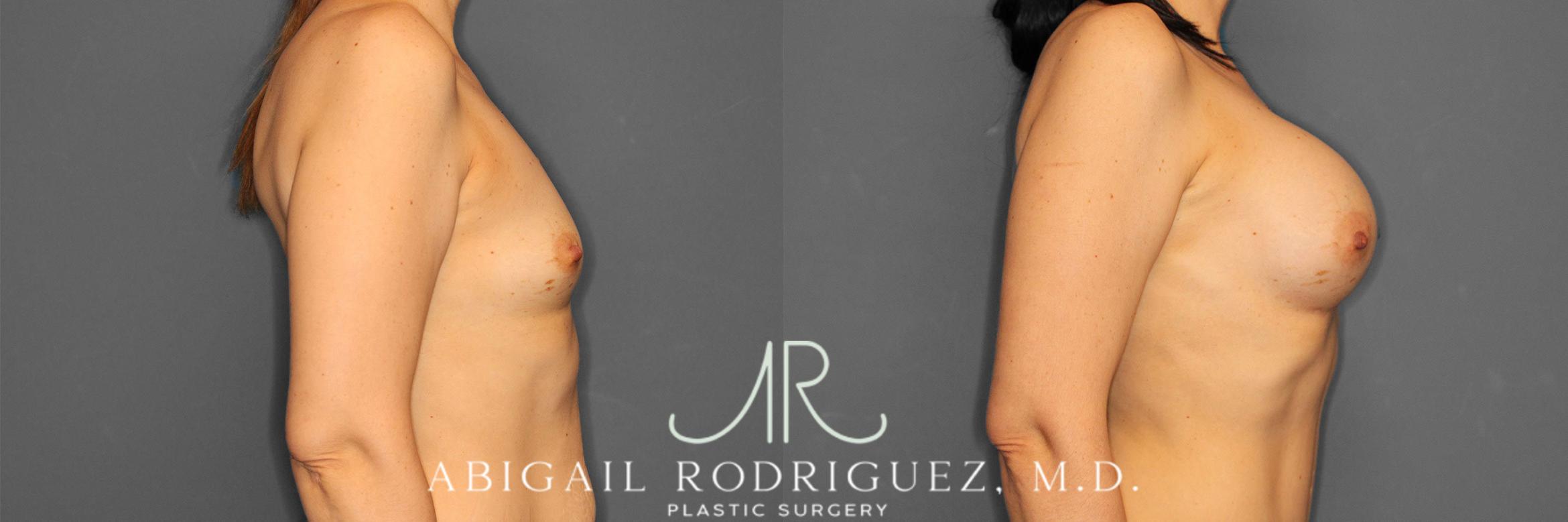 Before & After Breast Augmentation Case 257444 View 4 View in Houston, TX