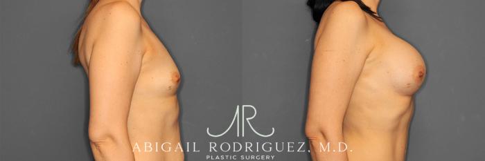 Before & After Breast Augmentation Case 257444 View 4 View in Houston, TX