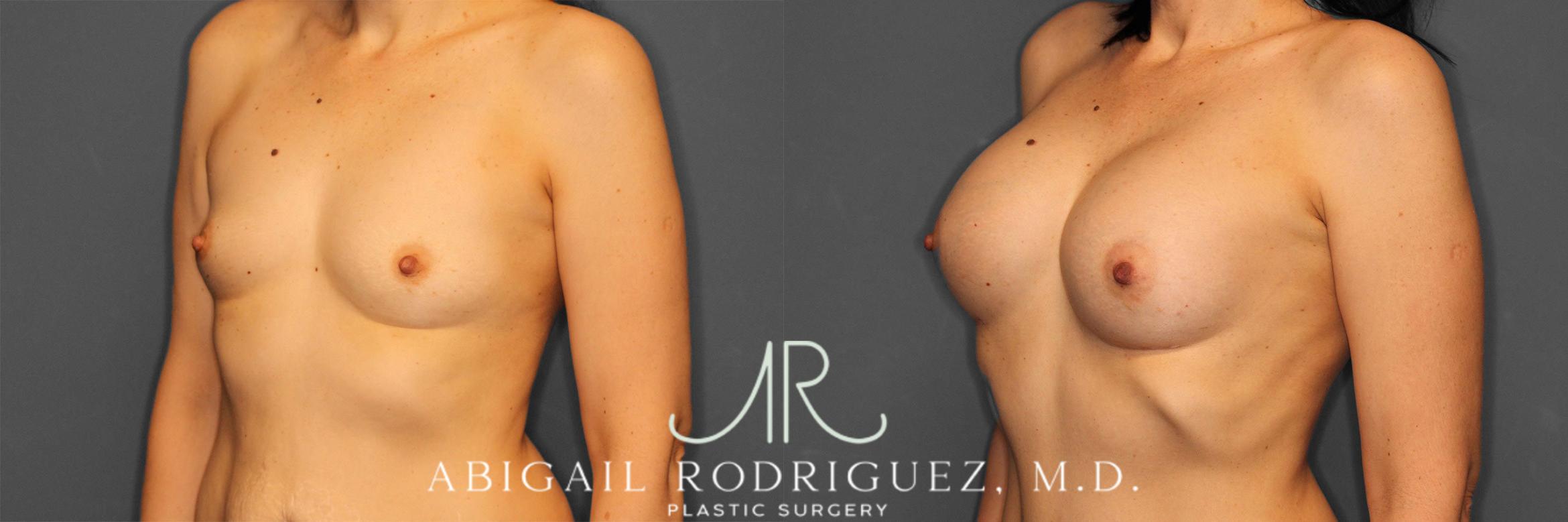 Before & After Breast Augmentation Case 257444 View 5 View in Houston, TX