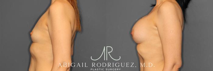 Before & After Breast Augmentation Case 257444 View 6 View in Houston, TX