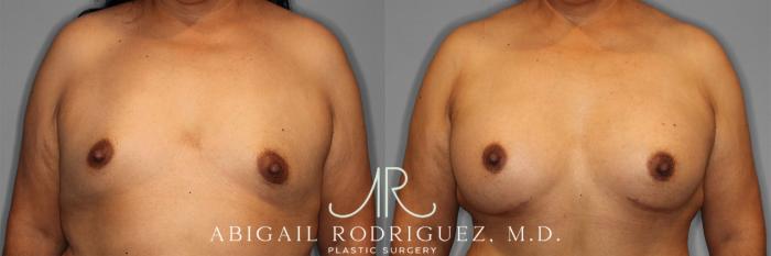 Before & After Breast Augmentation Case 257502 View 1 View in Houston, TX