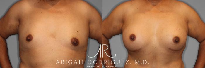 Before & After Breast Augmentation Case 257502 View 2 View in Houston, TX
