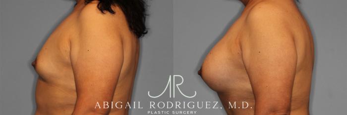 Before & After Breast Augmentation Case 257502 View 4 View in Houston, TX