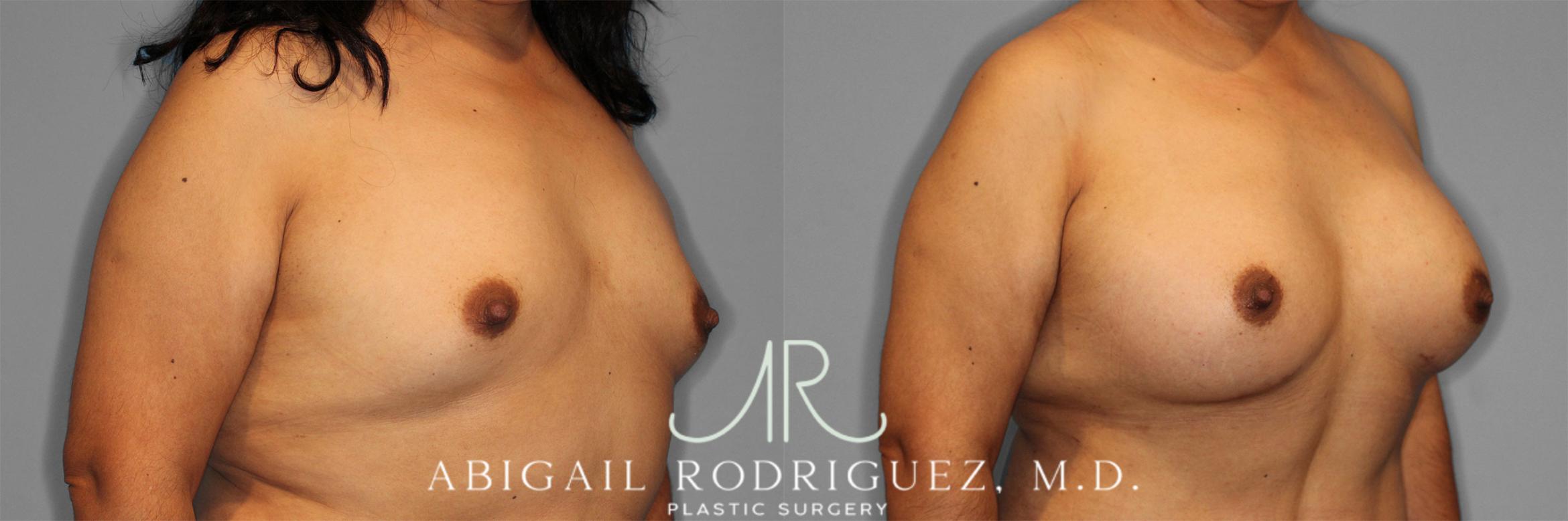 Before & After Breast Augmentation Case 257502 View 5 View in Houston, TX