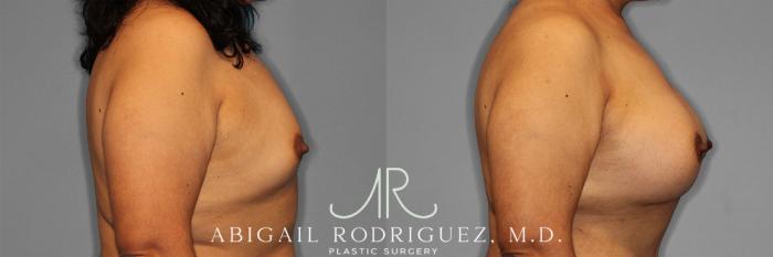 Before & After Breast Augmentation Case 257502 View 6 View in Houston, TX