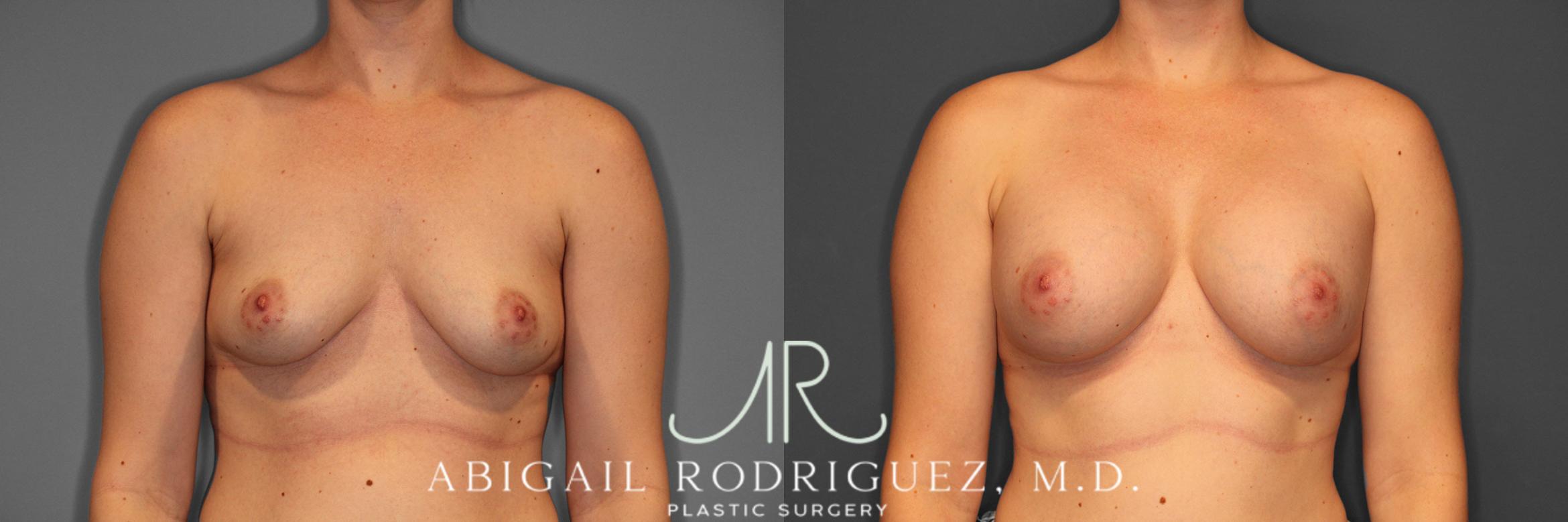 Before & After Breast Augmentation Case 257544 View 1 View in Houston, TX