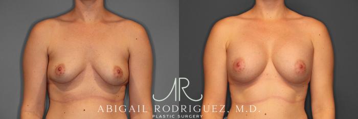 Before & After Breast Augmentation Case 257544 View 1 View in Houston, TX