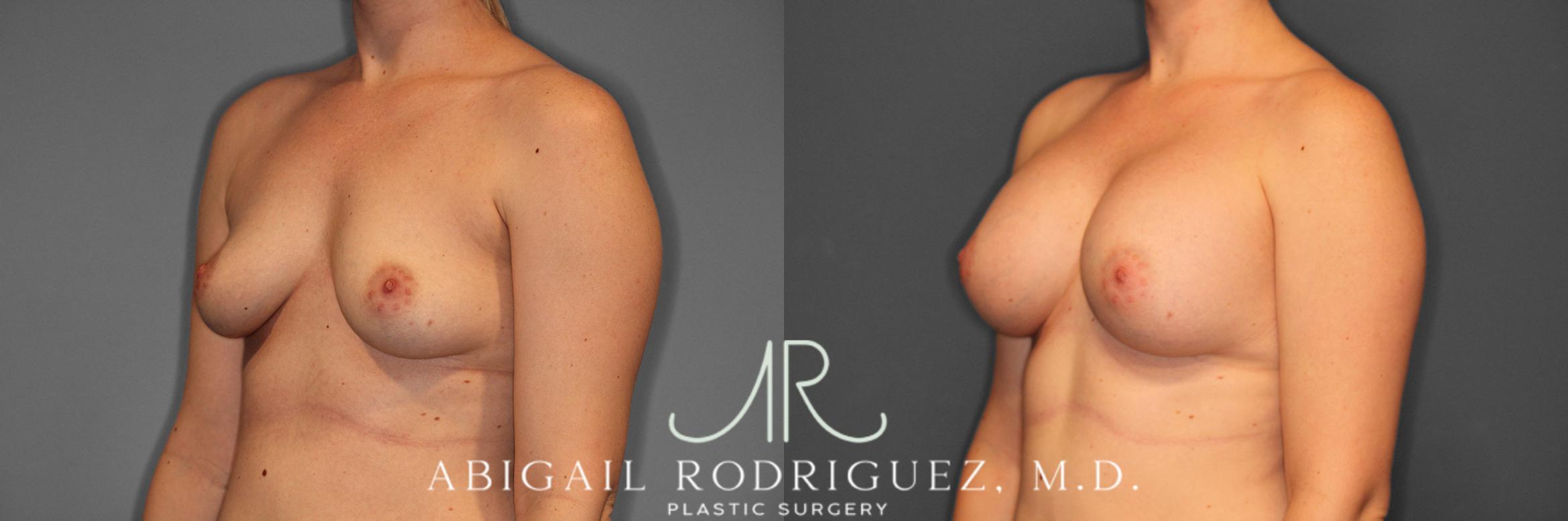 Before & After Breast Augmentation Case 257544 View 3 View in Houston, TX
