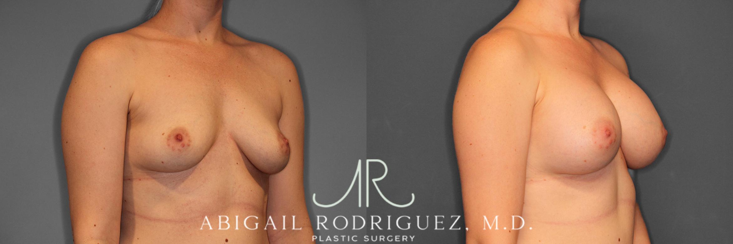 Before & After Breast Augmentation Case 257544 View 5 View in Houston, TX