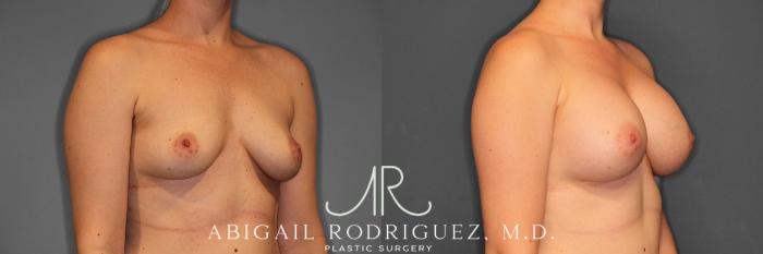 Before & After Breast Augmentation Case 257544 View 5 View in Houston, TX