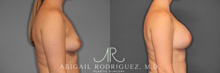 Before & After Breast Augmentation Case 257544 View 6 View in Houston, TX