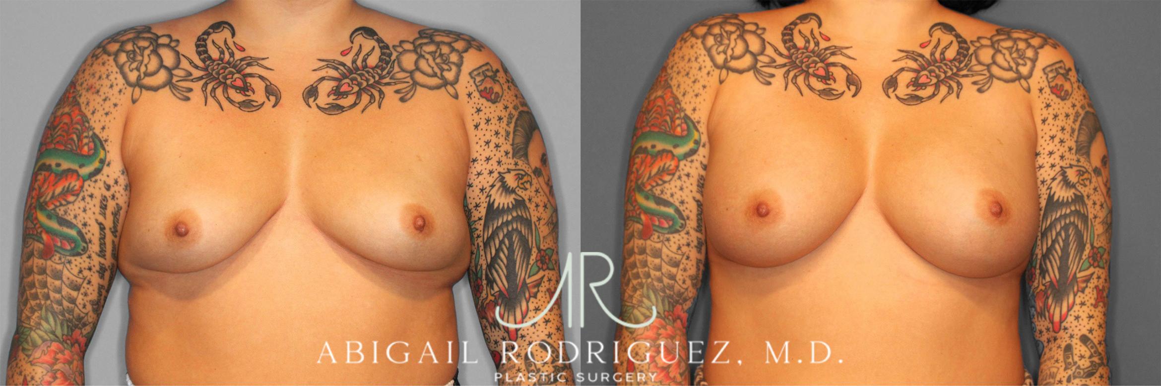 Before & After Breast Augmentation Case 258127 View 2 View in Houston, TX