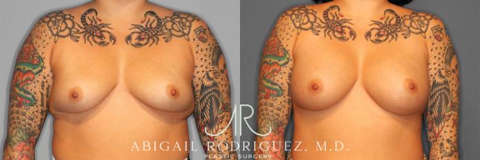 Before & After Breast Augmentation Case 258127 View 2 View in Houston, TX