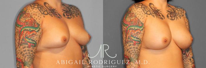 Before & After Breast Augmentation Case 258127 View 3 View in Houston, TX