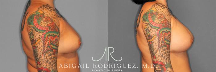Before & After Breast Augmentation Case 258127 View 4 View in Houston, TX
