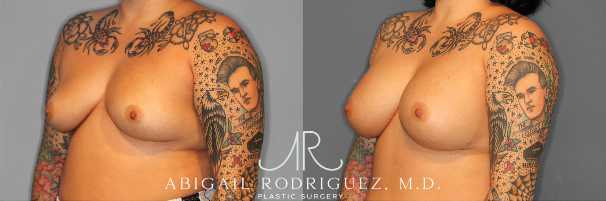 Before & After Breast Augmentation Case 258127 View 5 View in Houston, TX